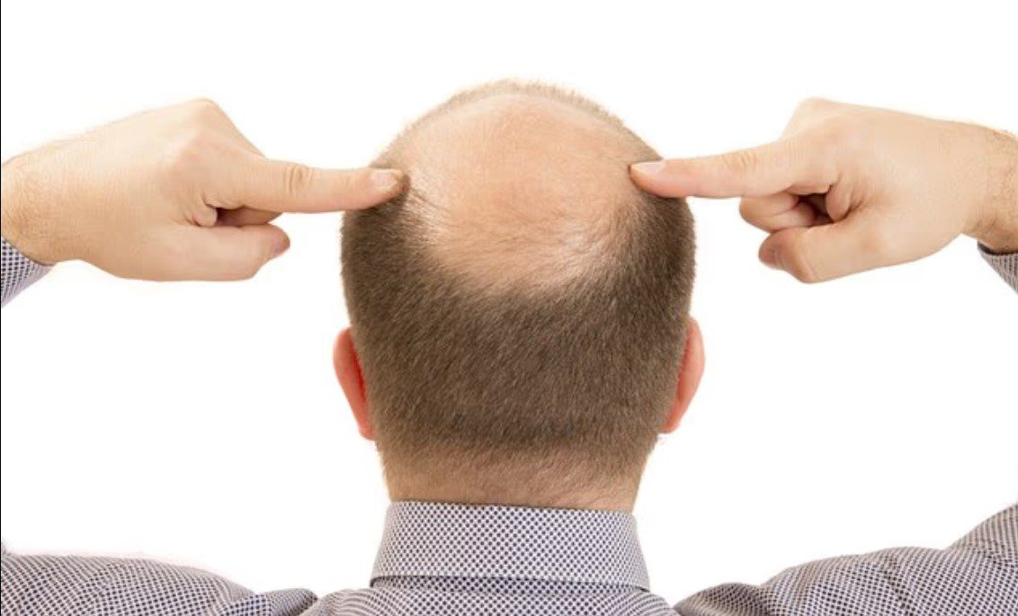 راهی ساده برای درمان ریزش مو